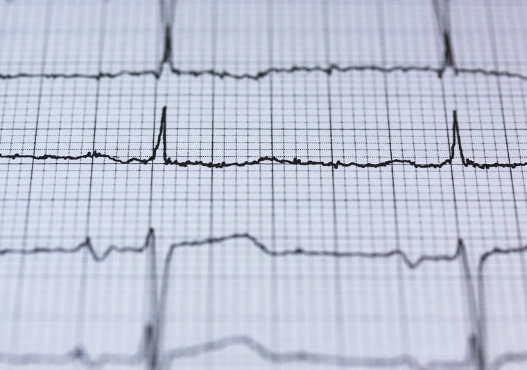 électrocardiogramme infarctus
