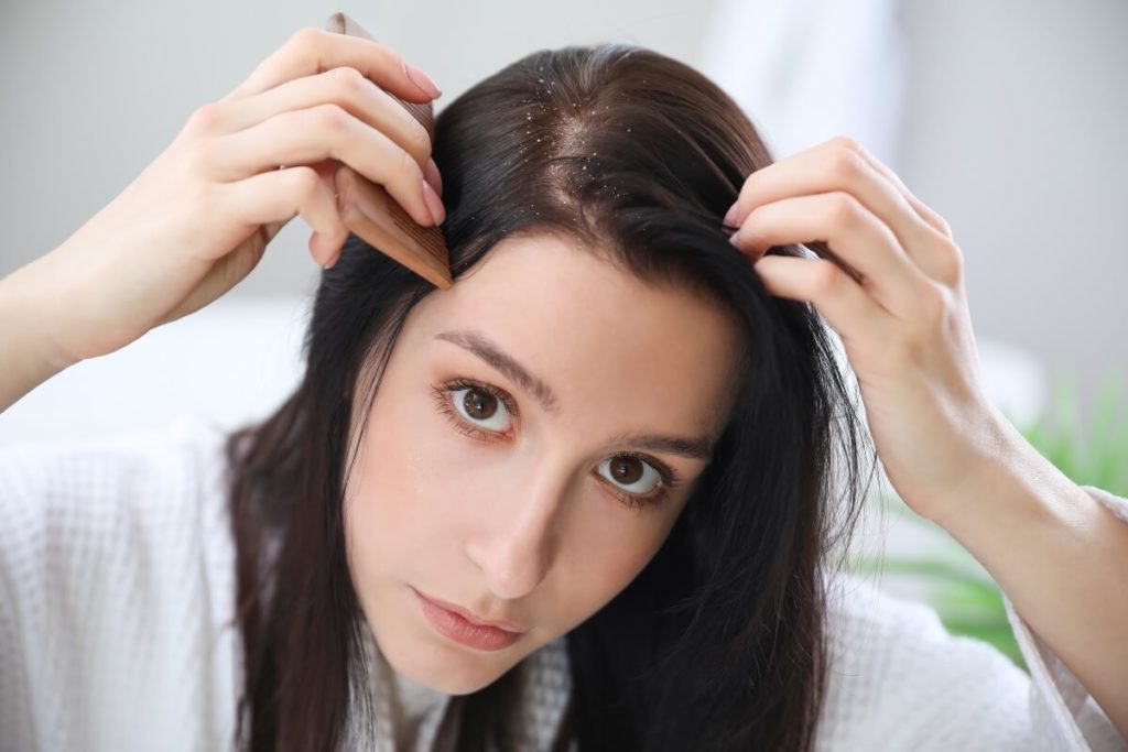 chute des cheveux